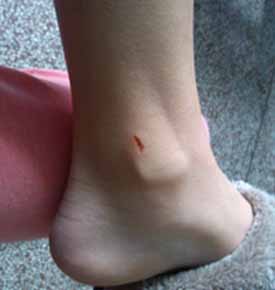 小伤口也有可能发展为大病